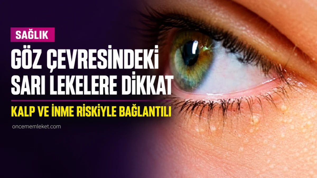 G&ouml;z &ccedil;evresindeki sarı lekelere dikkat: Kalp krizi ve inmeyle bağlantılı bulundu